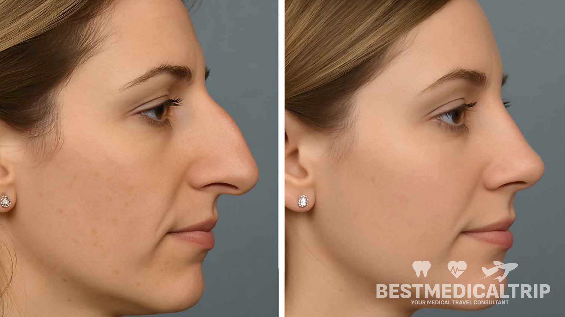 Nose Job Rhinoplasty Before After